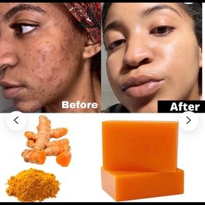Turmeric soaps for black spots and healthy skin